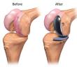 partial-knee-replacement